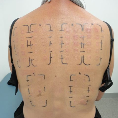 ALLERGY PATCH TESTING