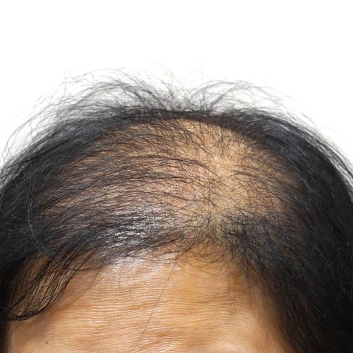 Specialist Dermatology alopecia female hairloss Itchy Scalp Male Balding