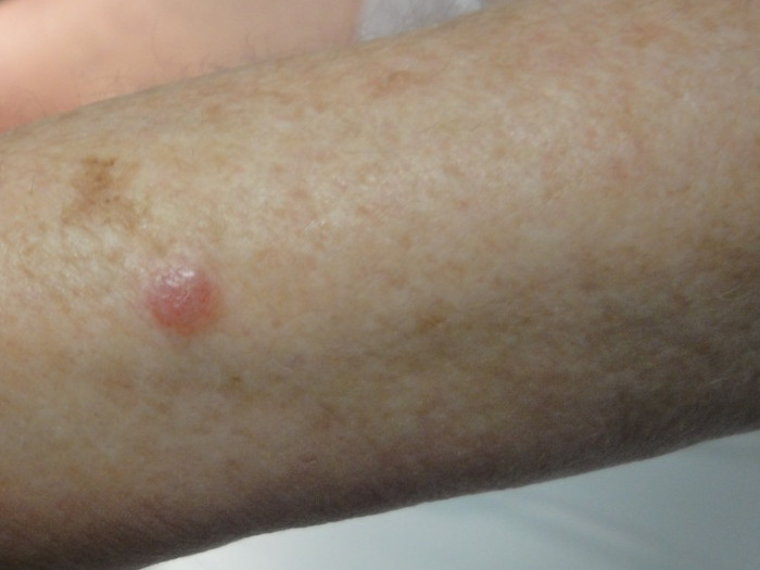 Stå sammen pouch tør Non-Melanoma Skin Cancer (NMSC) – South East Dermatology